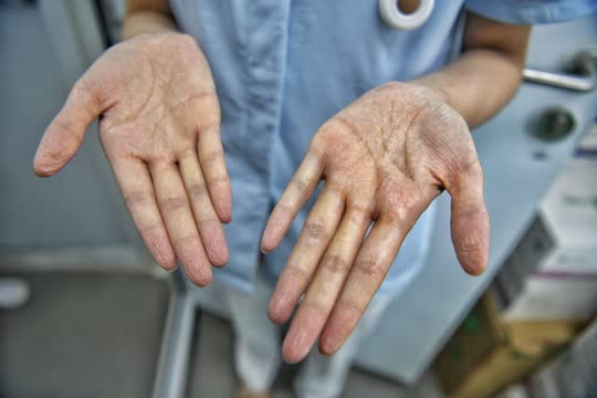 醫務人員雙手長時間在膠皮手套內被汗水泡白起皺。.jpg